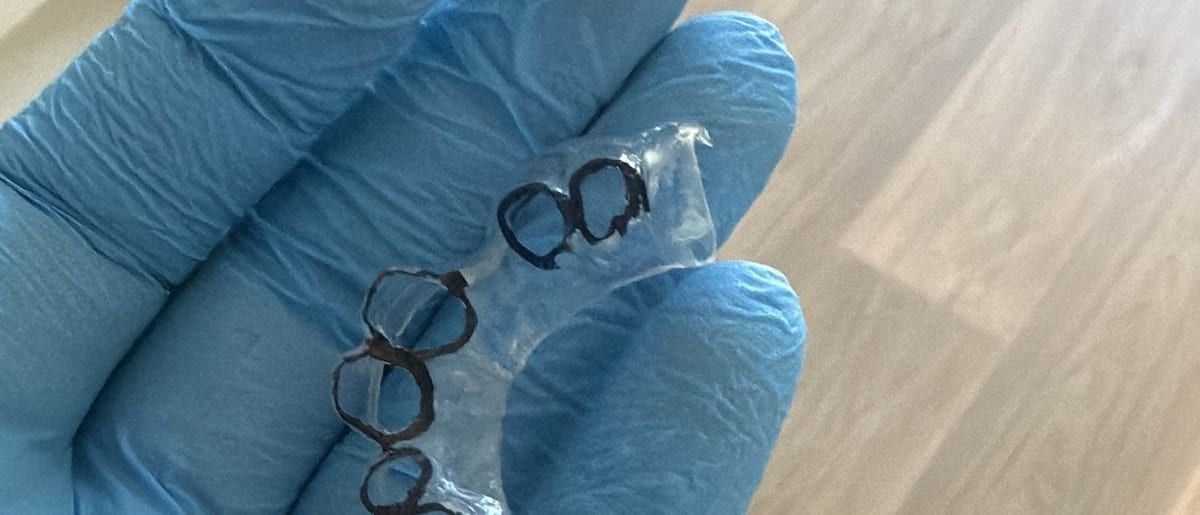 Une gouttière d'alignement transparente, réalisée sur mesure, tenue dans une main gantée